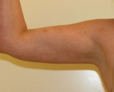 Feel Beautiful - Liposuction right arm - After Photo